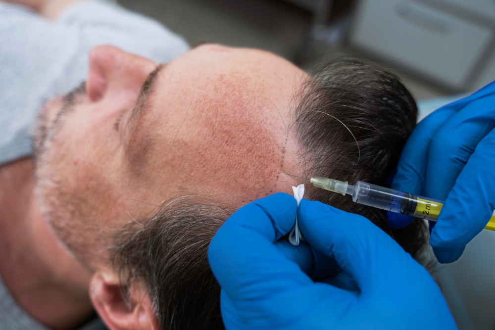 Understanding different types of Hair Transplantation Techniques